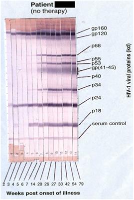 Divergent Expression of CXCR5 and CCR5 on CD4+ T Cells and the Paradoxical Accumulation of T Follicular Helper Cells during HIV Infection